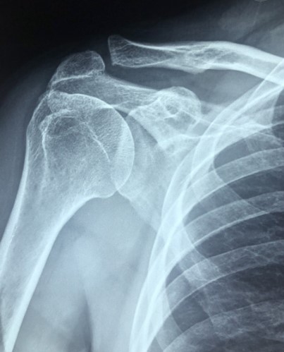 x-ray of shoulder & ribs